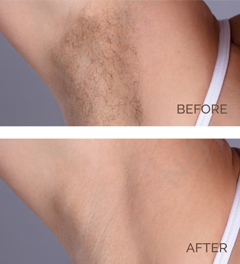 Underarm Hair Removal Before and After | Novique | Aesthetic Treatments | Doylestown & Bethlehem PA