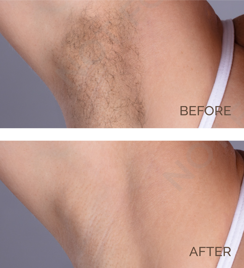 Underarm Hair Removal Before and After | Novique | Aesthetic Treatments | Doylestown & Bethlehem PA