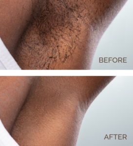 Men Underarm Underarm Hair Removal Before and After | Novique | Aesthetic Treatments | Doylestown & Bethlehem PA