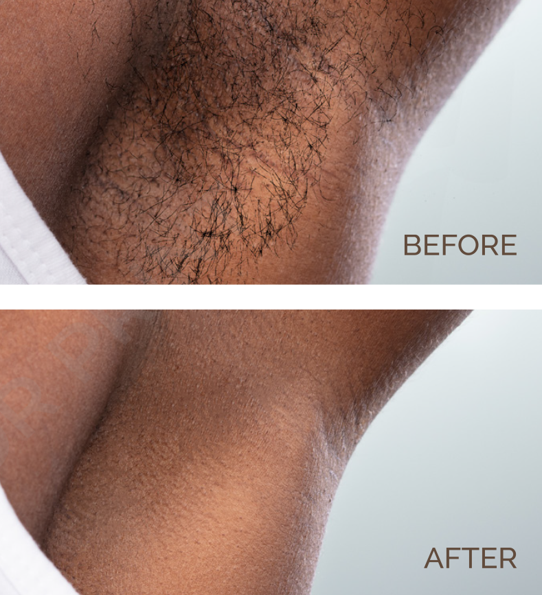 Men Underarm Underarm Hair Removal Before and After | Novique | Aesthetic Treatments | Doylestown & Bethlehem PA