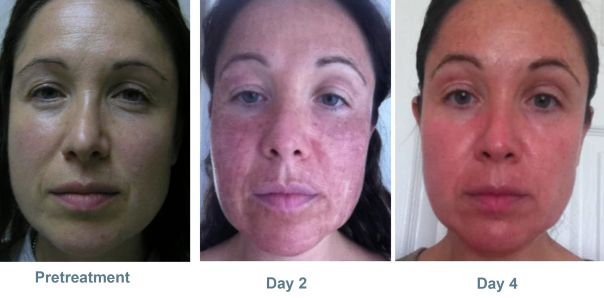 Phoenix CO2 Laser System Novique Medical Aesthetics