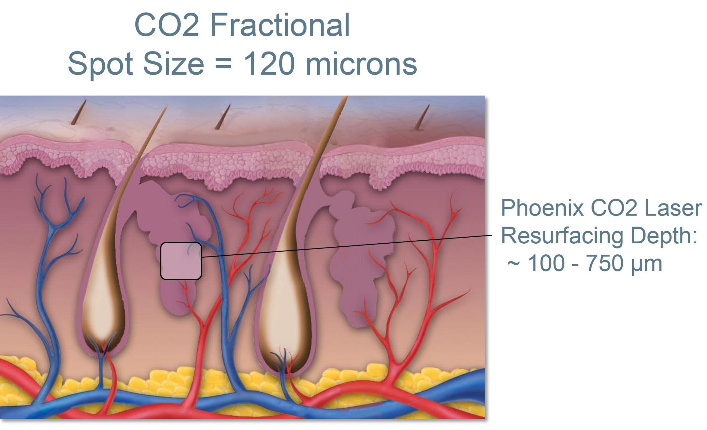 spit-size Phoenix Treatment Method