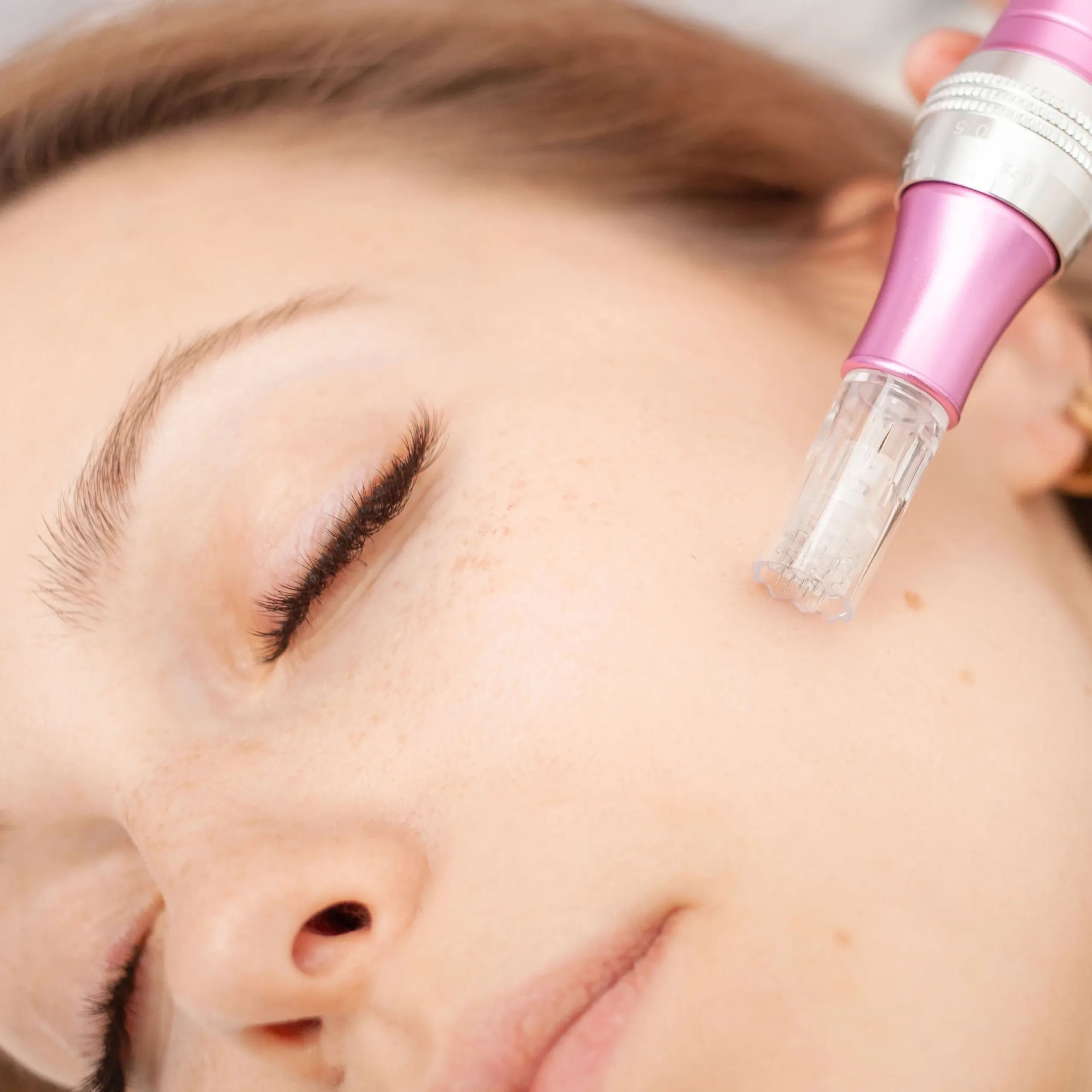 Microneedling